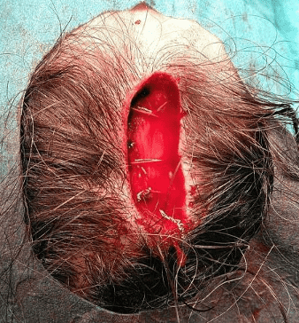 Surgical incision on scalp with staples