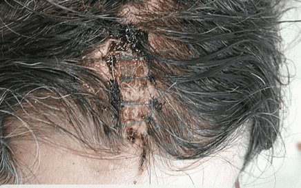 Close-up of sutured head wound.