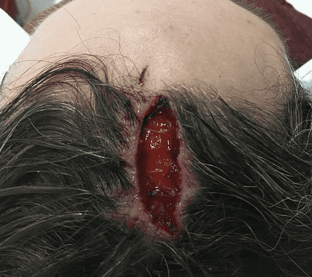Close-up of large head wound.