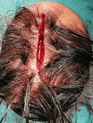 Surgical incision on scalp with stitches