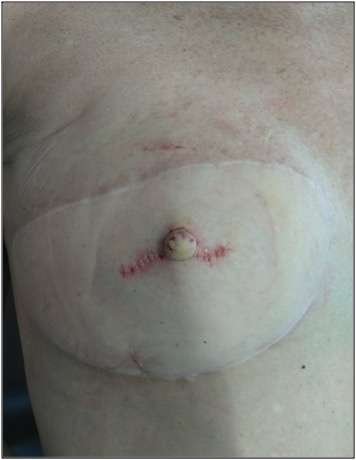 Post-surgical reconstructed breast with scarring