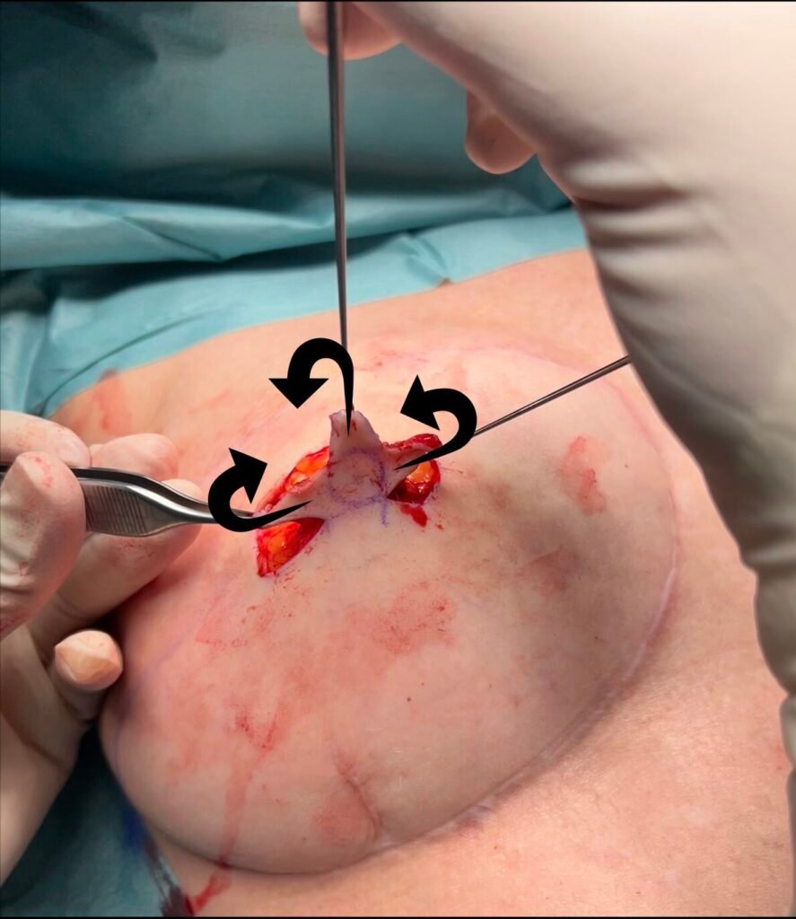 Surgical procedure on skin with tools