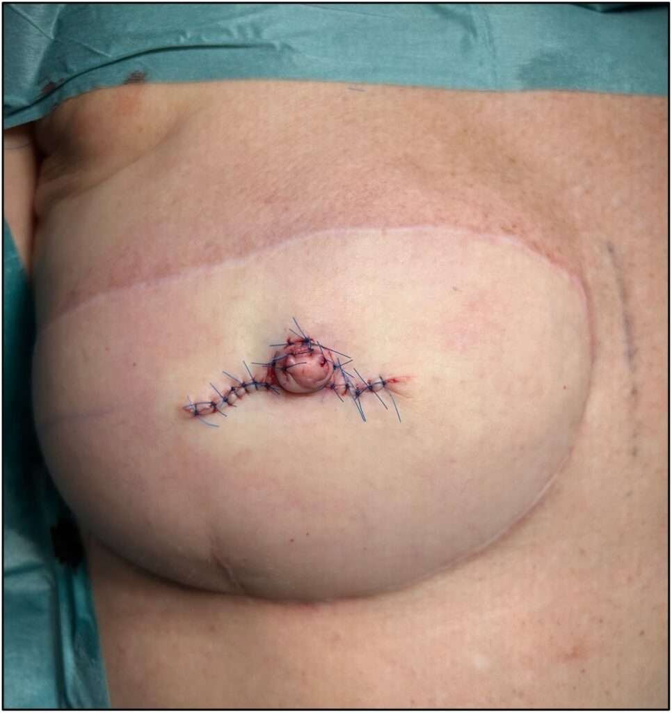 Surgical stitches on a reconstructed breast