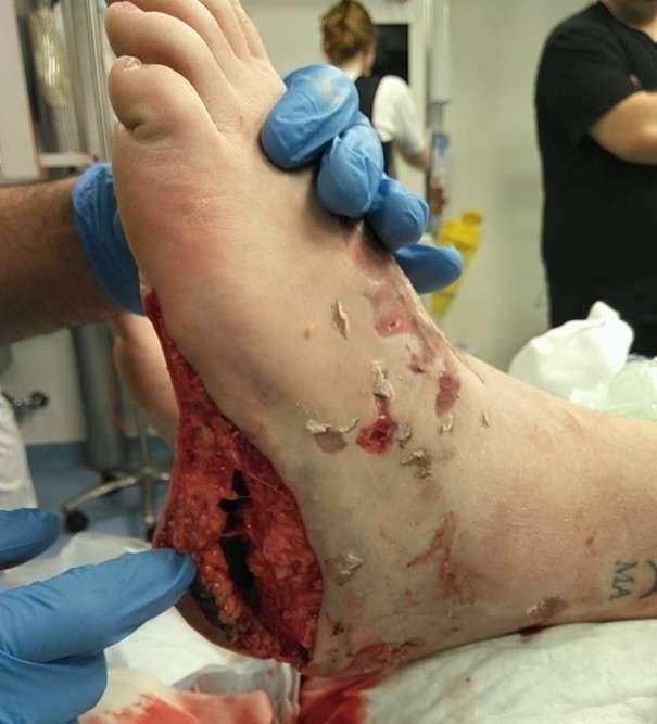 Severe foot injury with exposed tissue