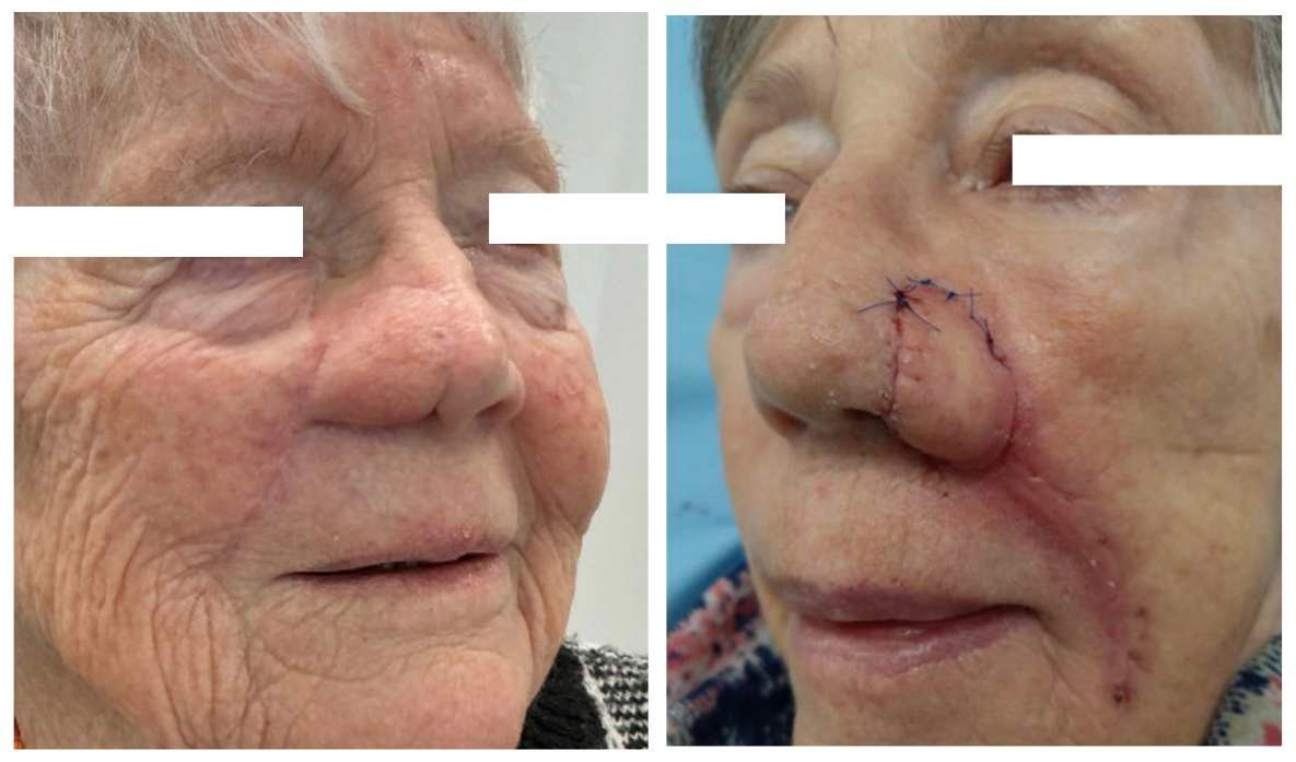Elderly woman before and after nose surgery