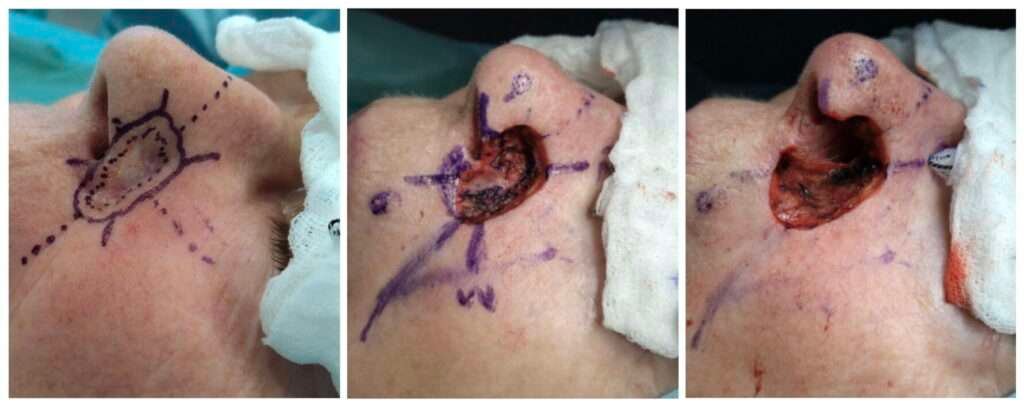 Sequential images of nasal surgery procedure