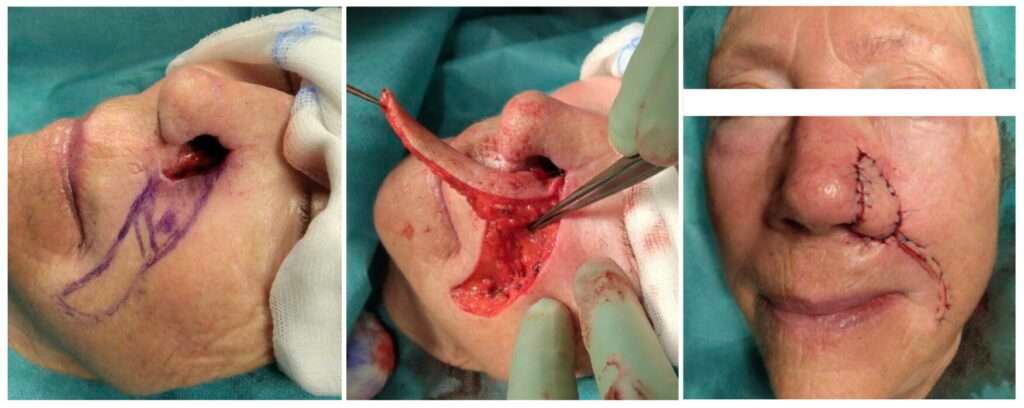 Surgical procedure on a patient's face