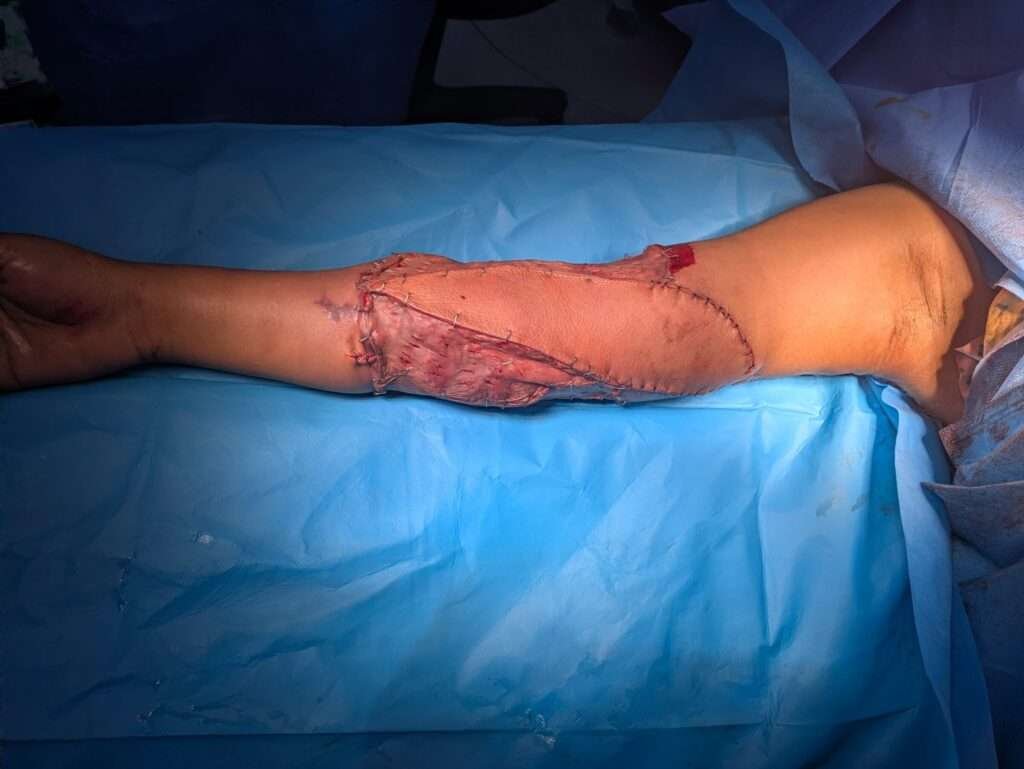 Arm with surgical stitches on blue drape
