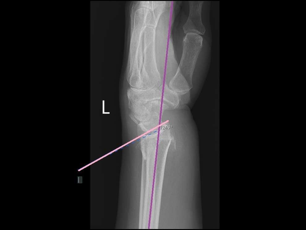 X-ray of a left wrist with angle measurement