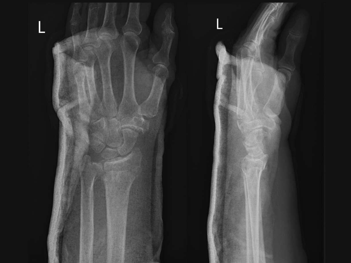 X-ray of a left hand with injury