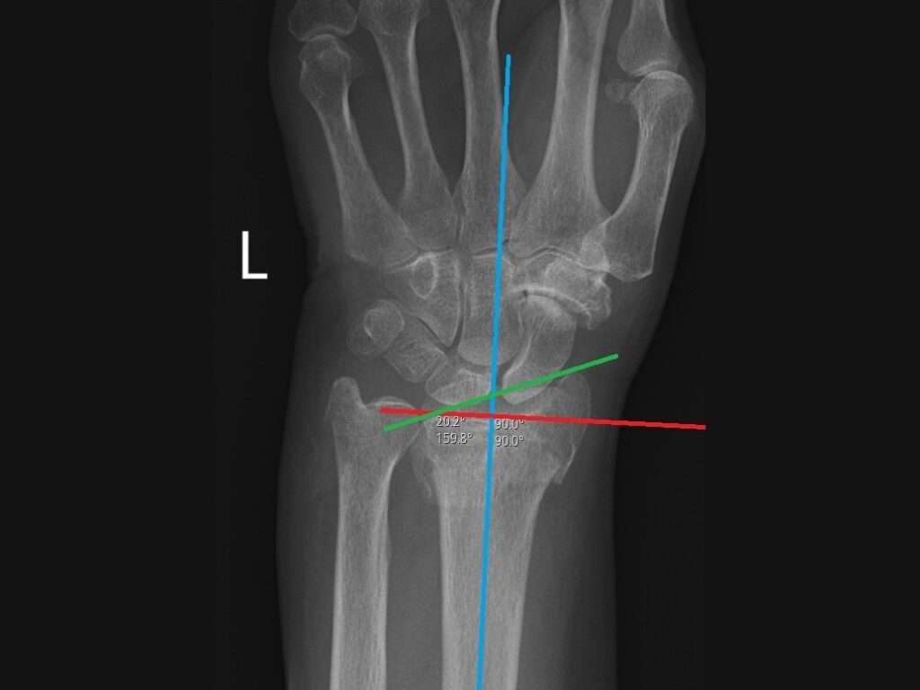 X-ray of a left human wrist with marked angles