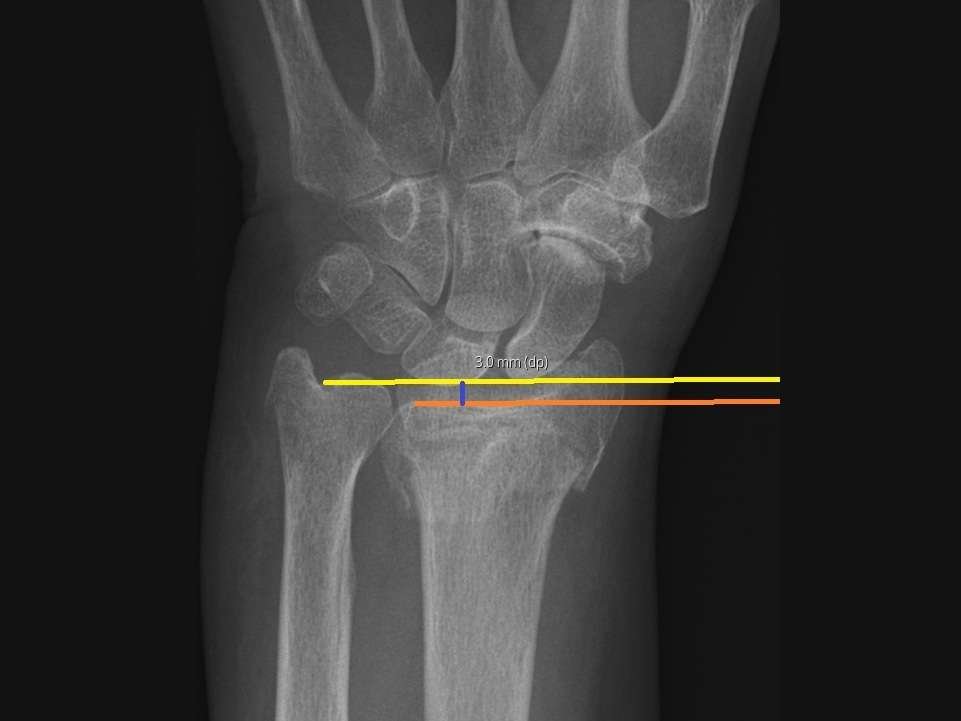 X-ray of human wrist with measurements