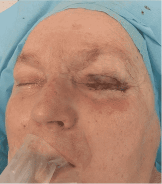 Person's face with medical tubing, resting.