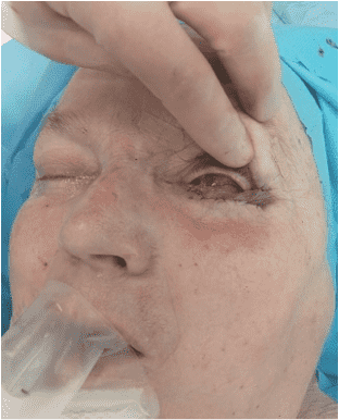 Eye surgery procedure in progress