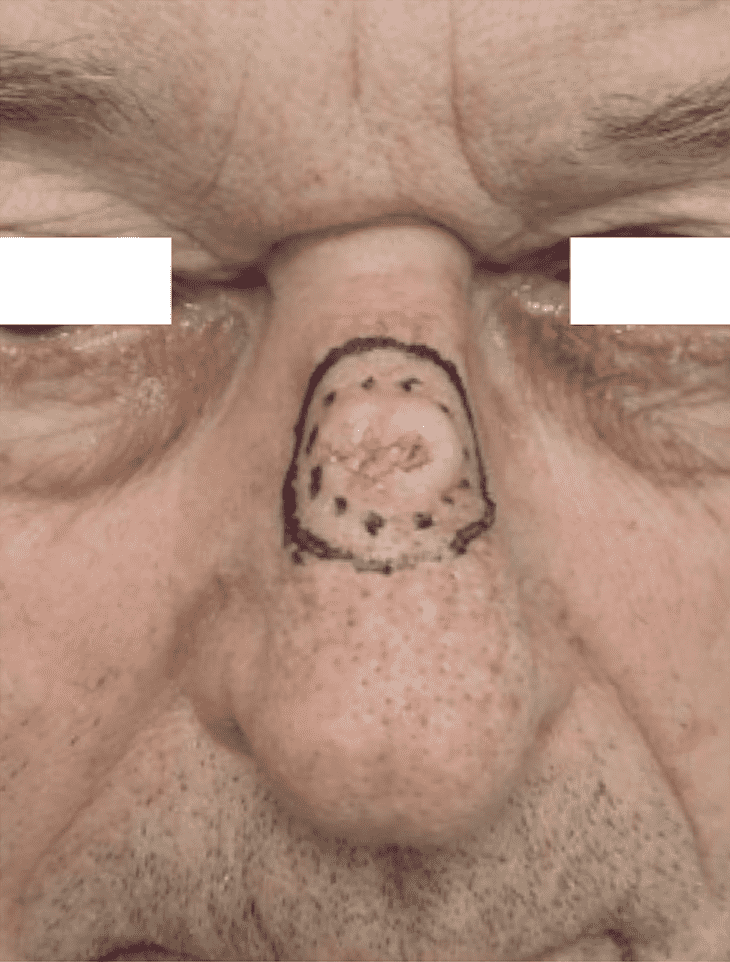 Skin lesion marked on the nose