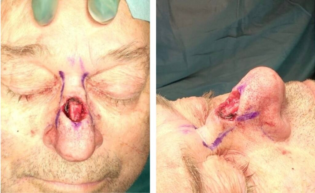 Close-up of nose with surgical markings.