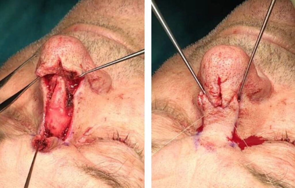Surgical images showing a procedure on the nose