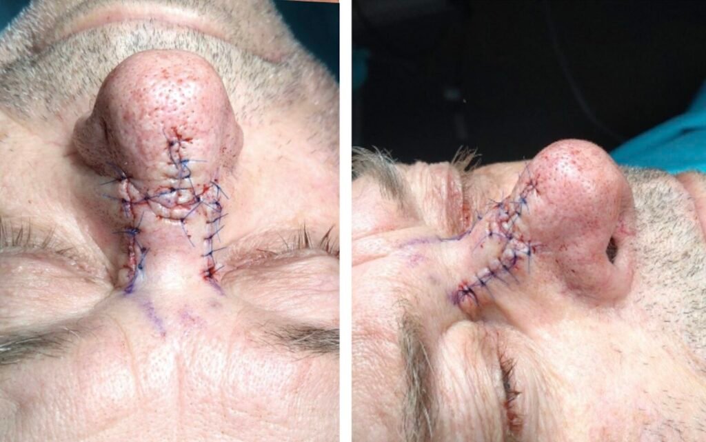 Close-up of surgical stitches on a nose
