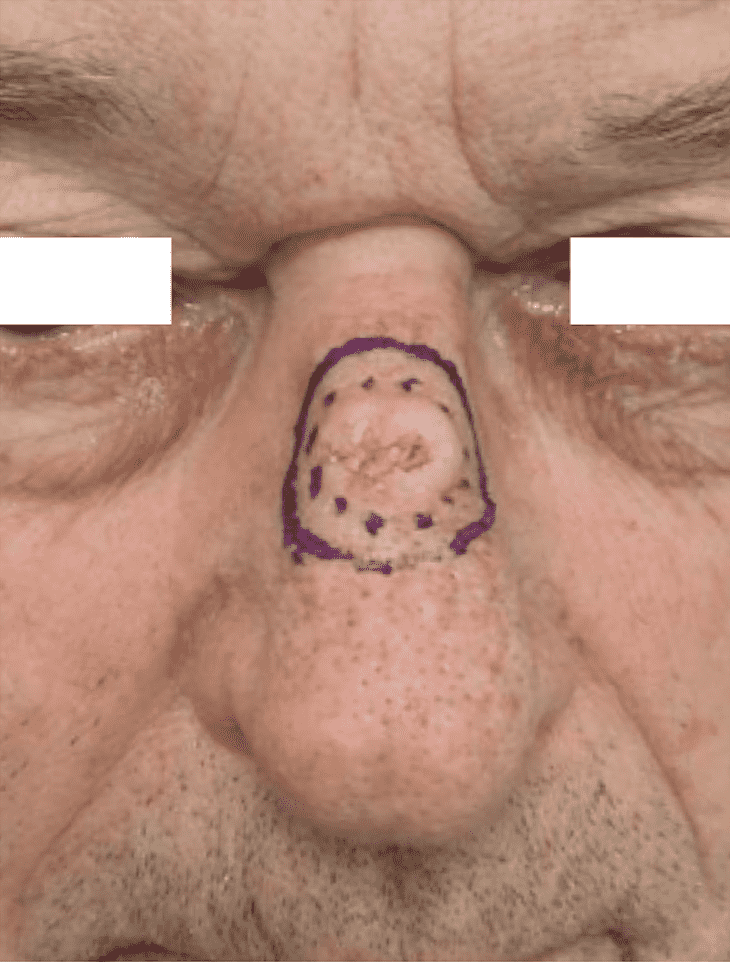 Marked lesion on nose for skin examination