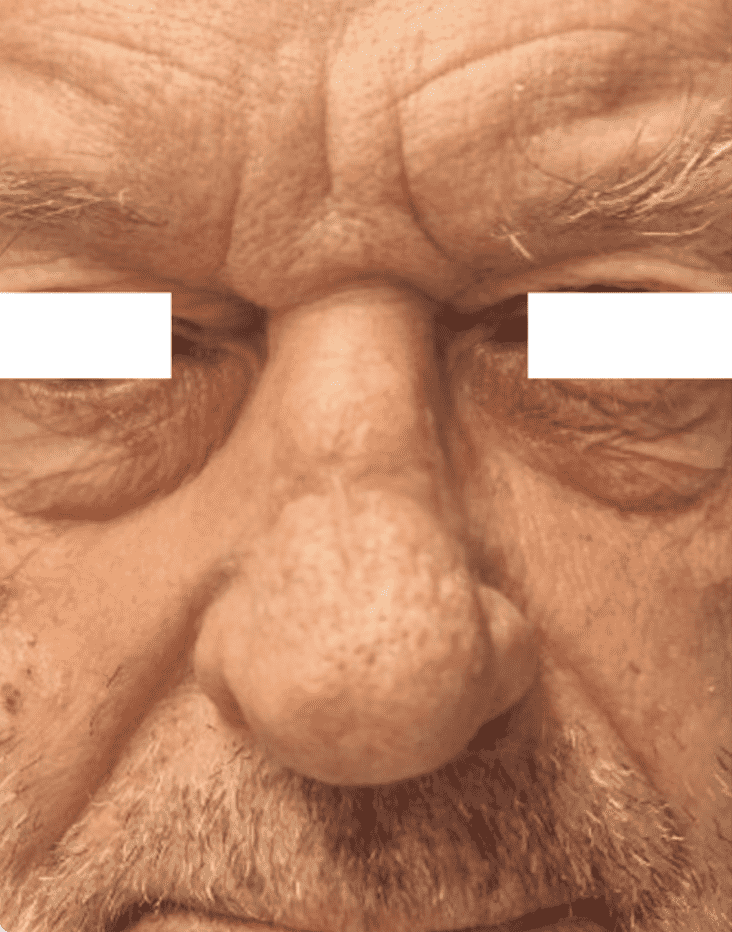 Close-up of a man's nose with rhinophyma