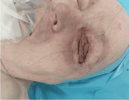 Close-up of an eye and stitches on face