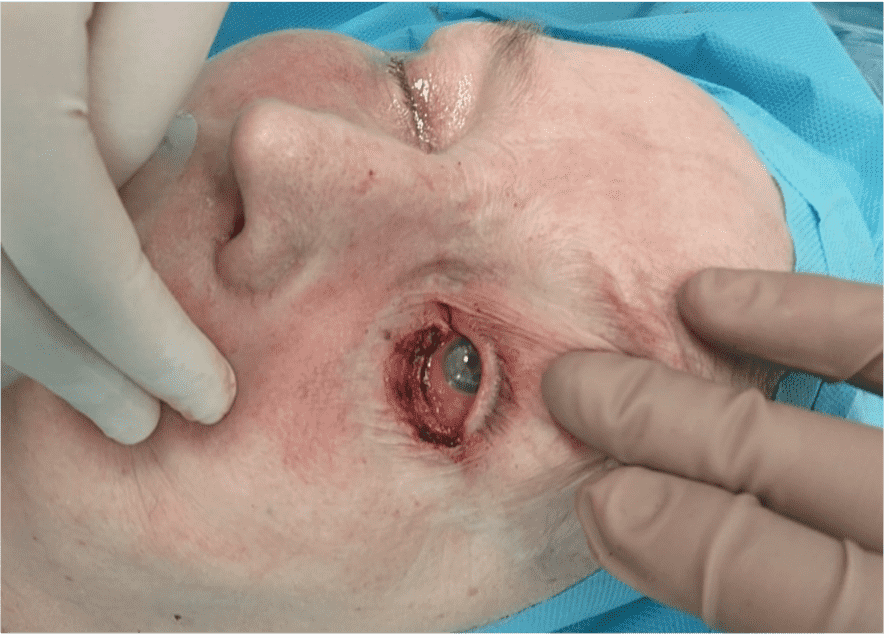 Medical procedure on patient's eye