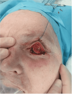 Surgical procedure on patient's eye area