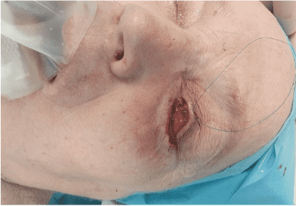 Patient with eye surgery and oxygen mask