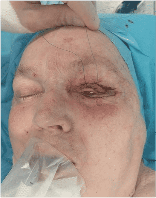 Patient during surgical procedure with eye stitches.