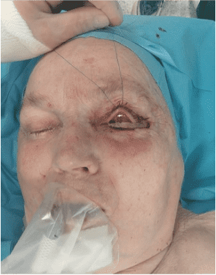 Post-operative facial surgery with stitches
