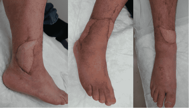 Leg with surgical scars and skin graft