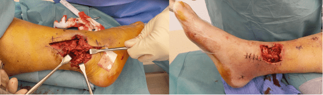 Surgical procedure on a foot with open wounds.