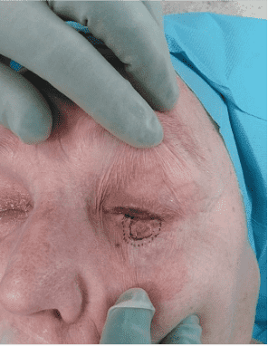 Preparation for surgical procedure near eye.