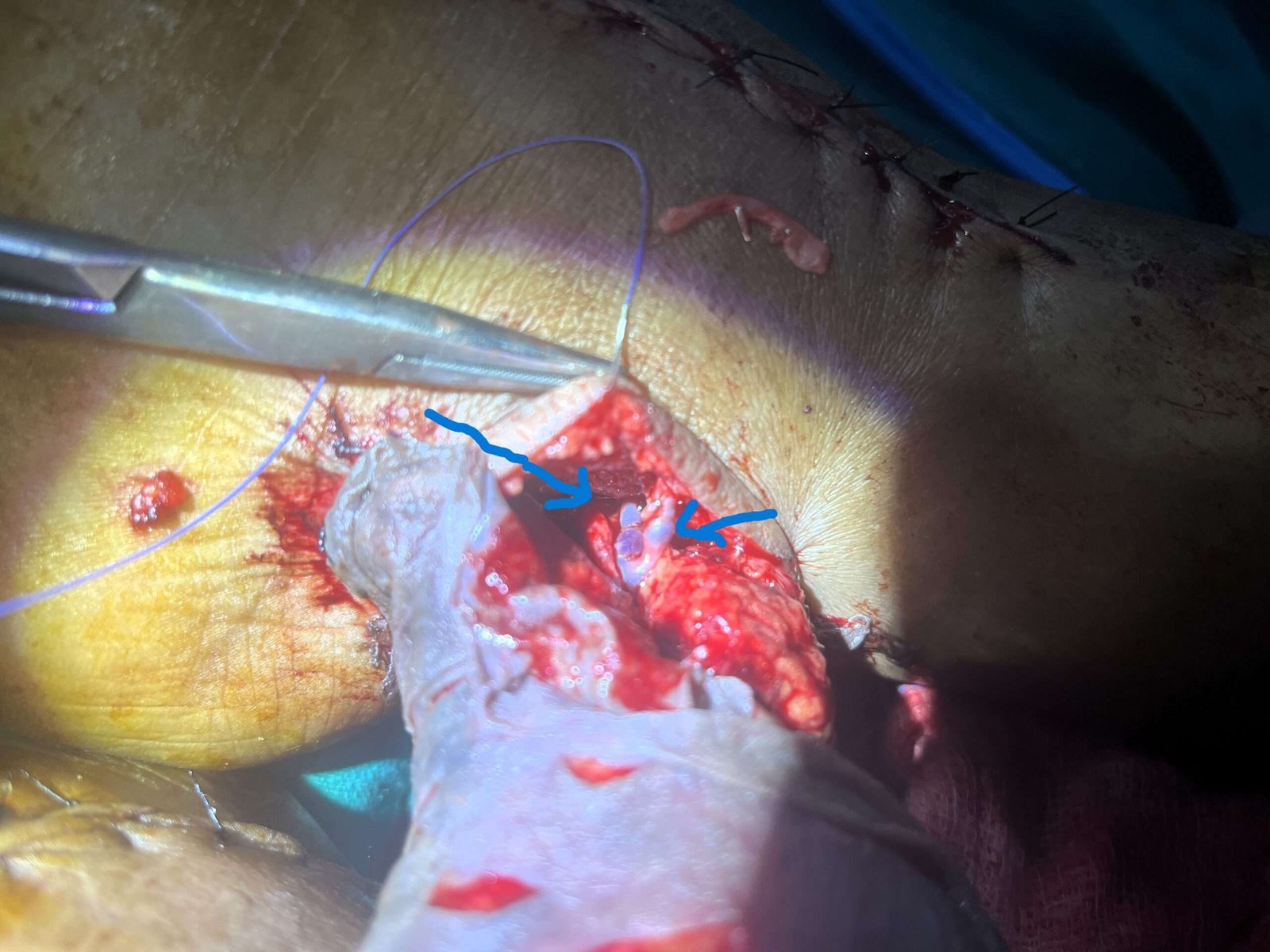 Surgical procedure with incision and clamps