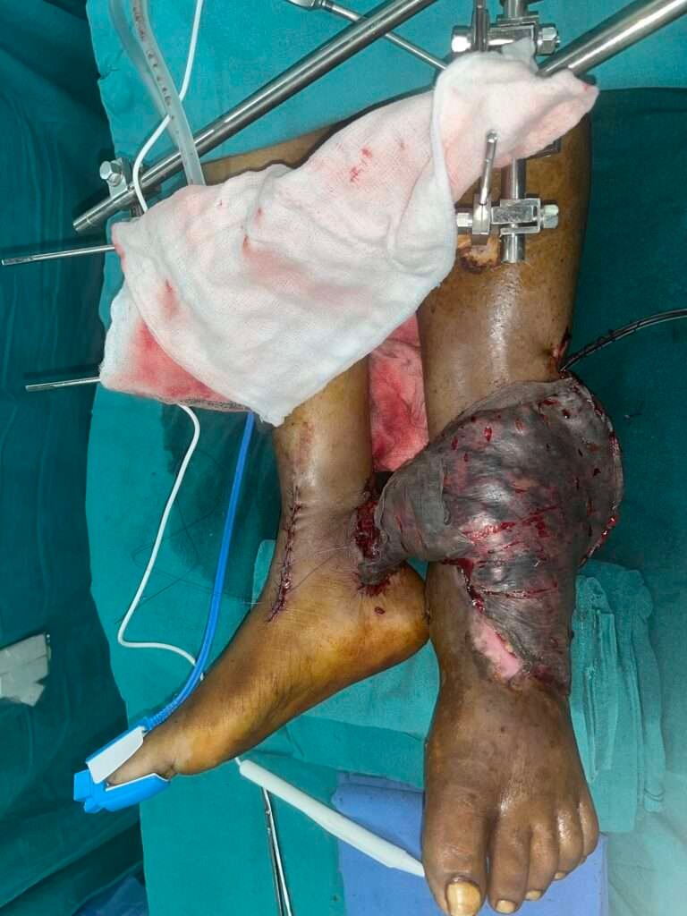 Surgical wound with external fixation on leg