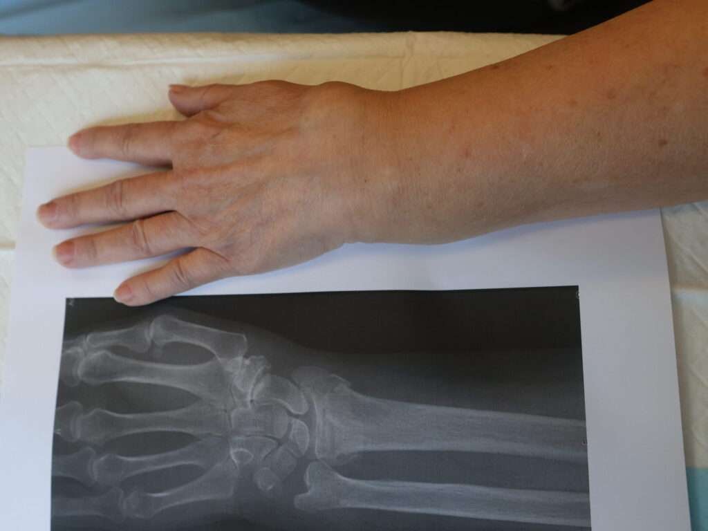 Hand placed over wrist X-ray image