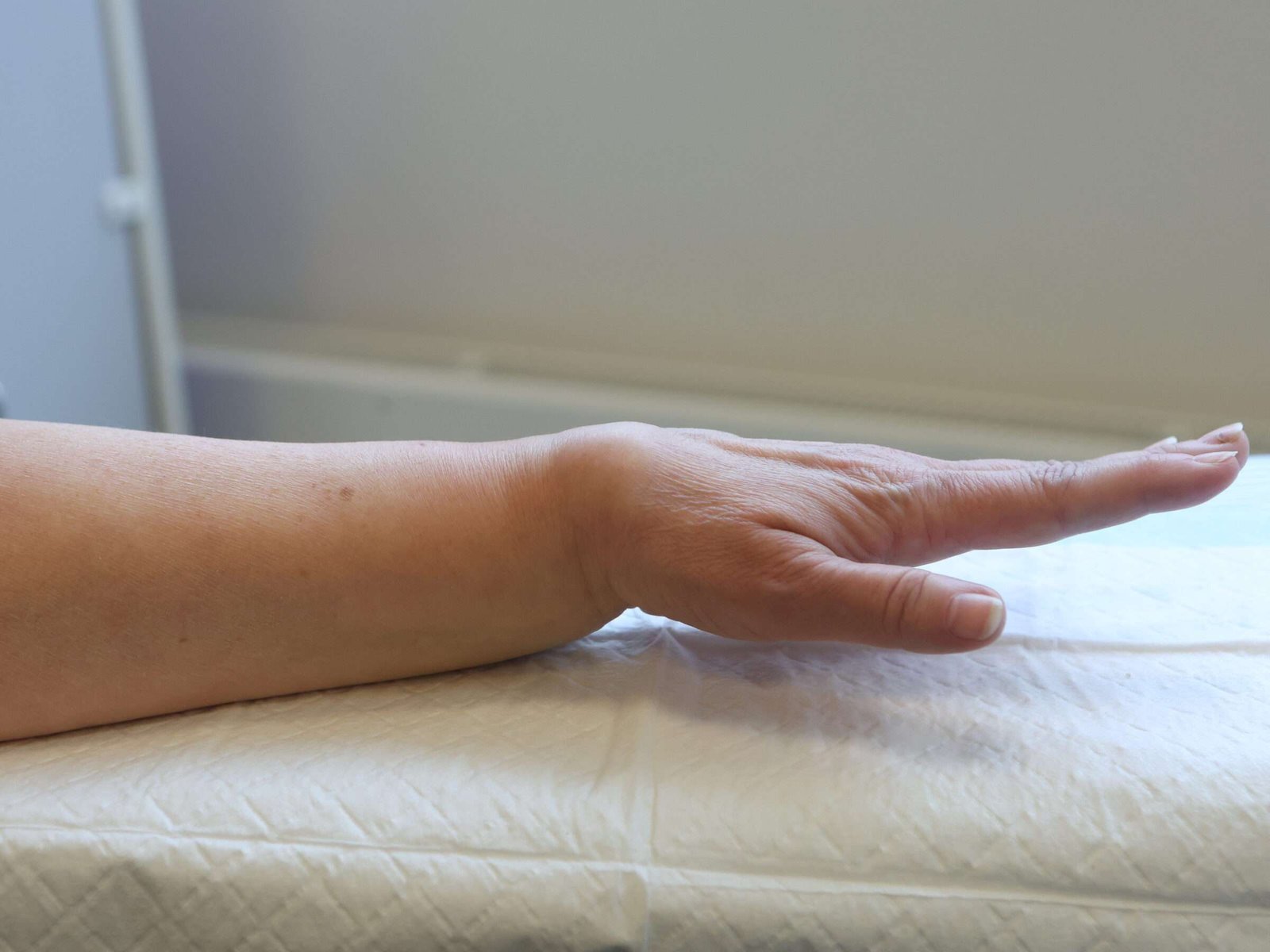 Swollen hand resting on table