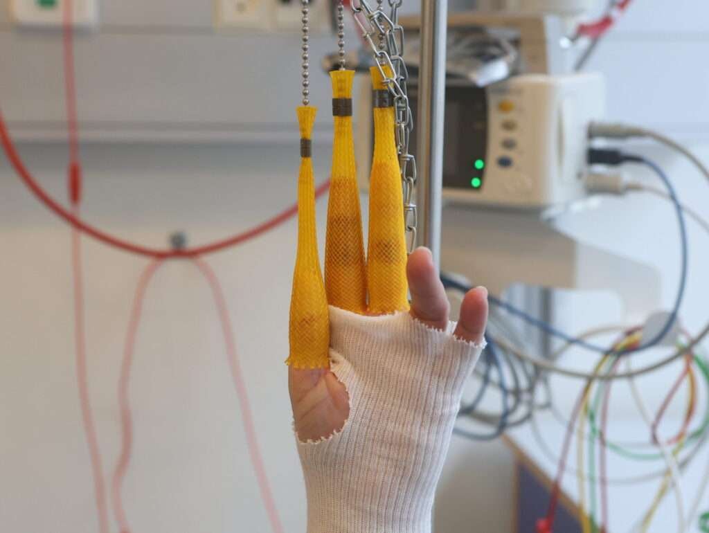 Hand with yellow splints in medical setting.