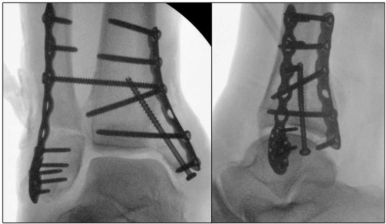 X-ray of ankle with surgical screws and plates