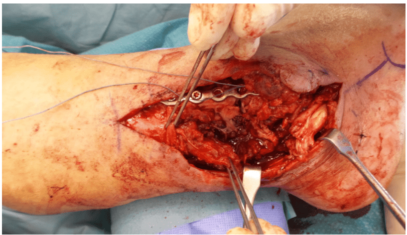 Surgical procedure on open leg wound