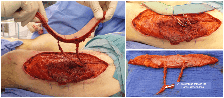 Medical surgical procedure on a leg.