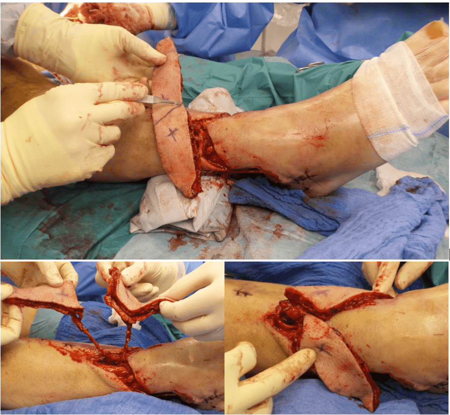 Surgical procedure on leg with skin grafting