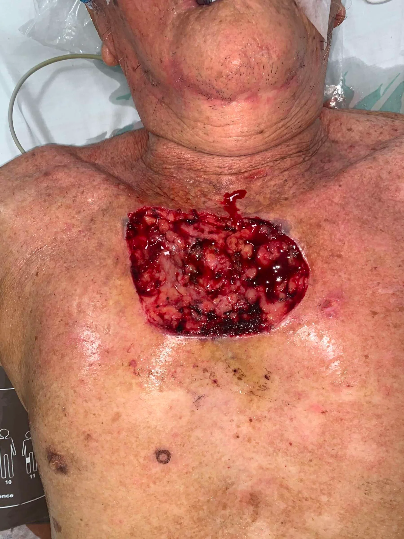 Large open wound on chest of elderly person